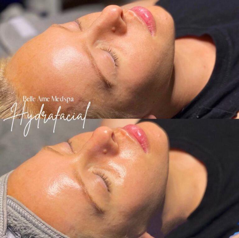 before and after Dermaplane Facial OKC