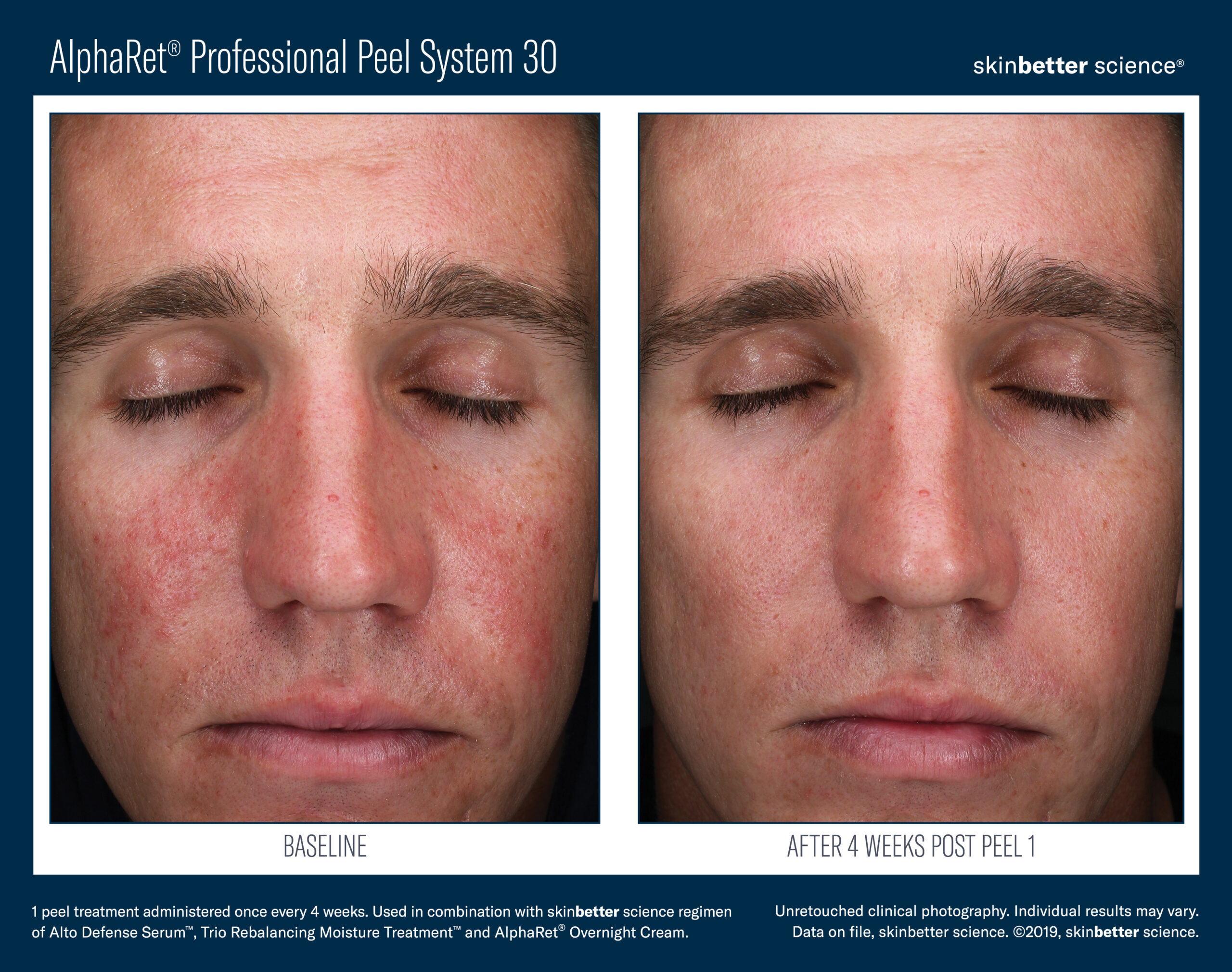 AlphaRet Professional Peel System Before After 1 treatment