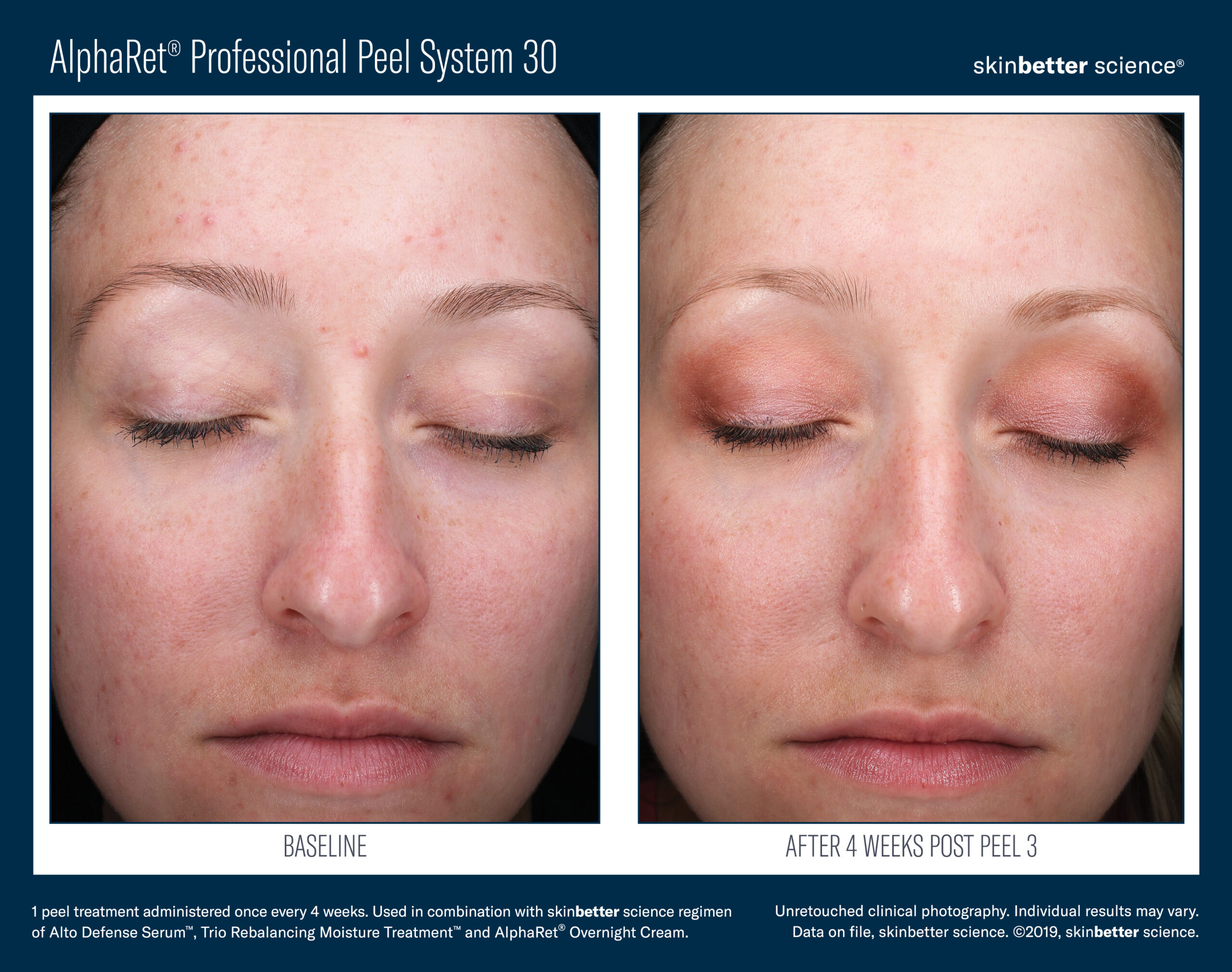 AlphaRet Professional Peel System Before After 3 treatments AlphaRet Professional Peel System Before After 3 treatments