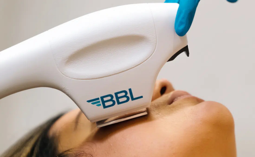 Broadband Light Therapy facial treatment with BBL device for skin rejuvenation.
