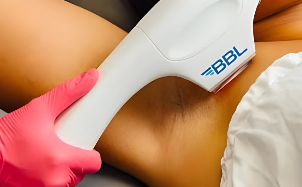Broadband Light Therapy hair removal treatment using Forever Bare BBL.