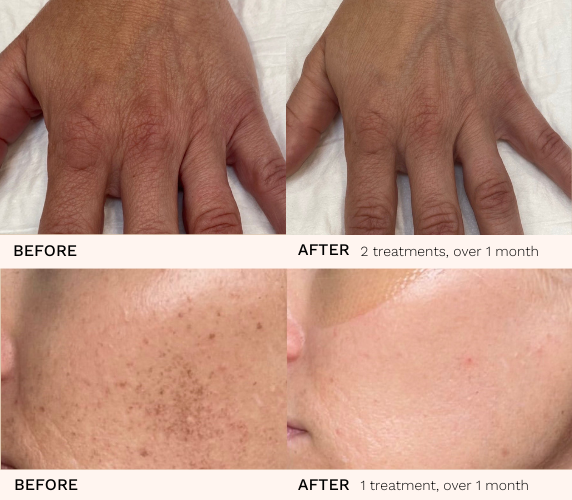 Broadband Light Therapy before and after results for hand rejuvenation and facial pigmentation.