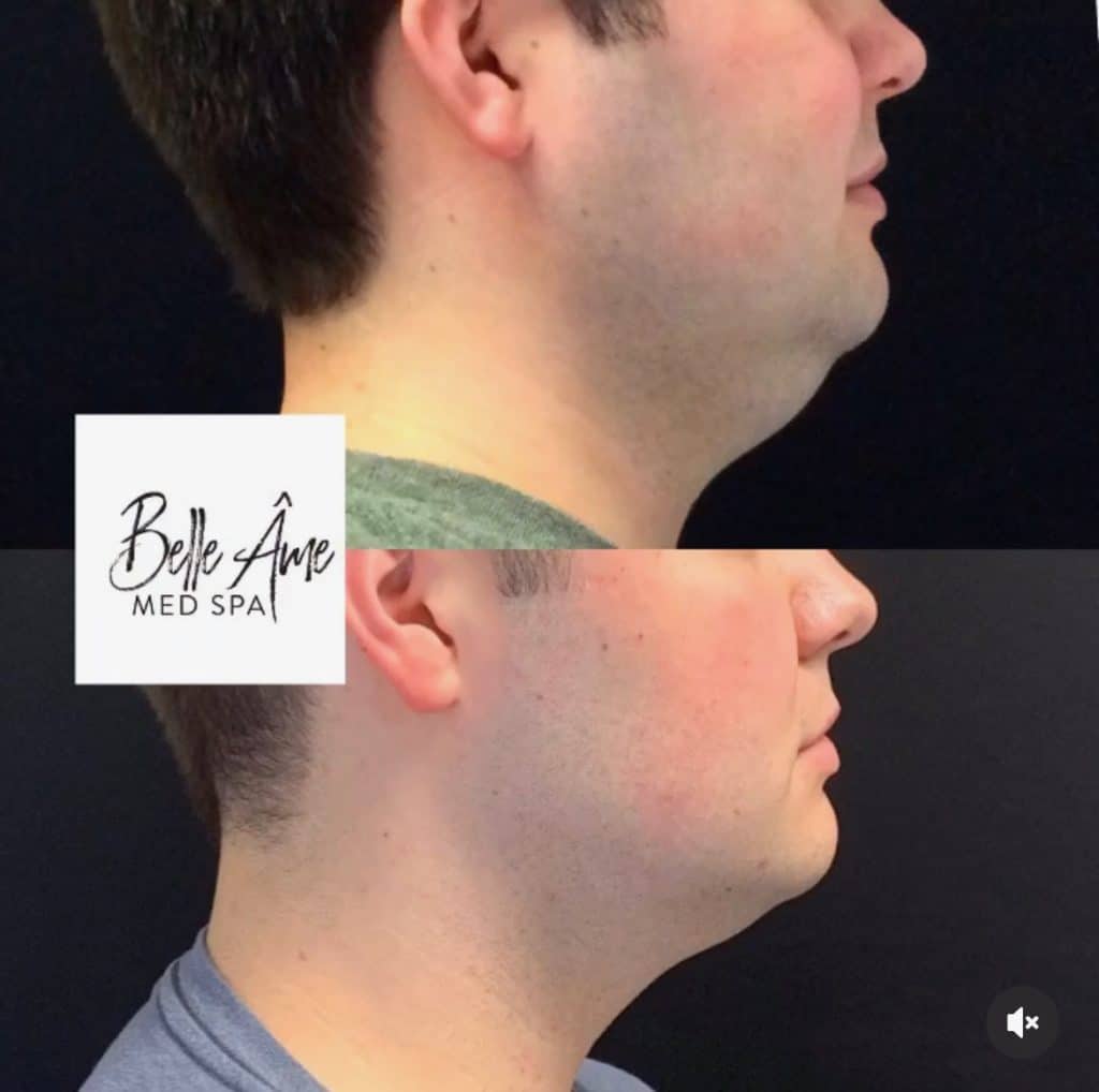 Coolsculpt rename 1024x1018 1