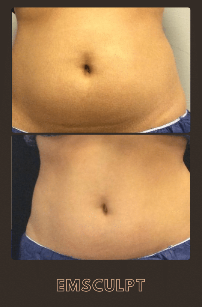 Emsculpt before and after results at Belle Âme Med Spa in Oklahoma City showing visible abdominal muscle toning.