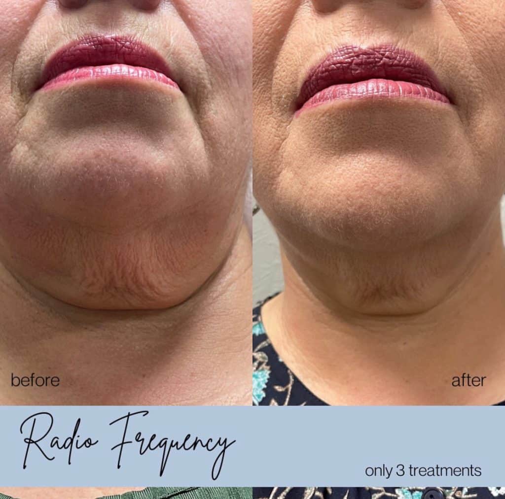 Venus Legacy before and after results at Belle Âme Med Spa in Oklahoma City showing improved neck tightening and reduced wrinkles.