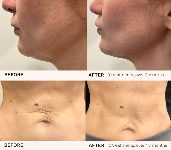 Venus Legacy before and after results showing neck tightening and abdominal skin smoothing at Belle Âme Med Spa in Oklahoma City.