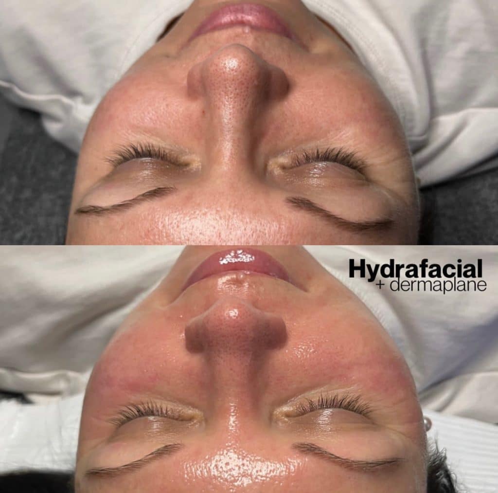 Dermaplane treatment before and after showing refined skin texture and glow