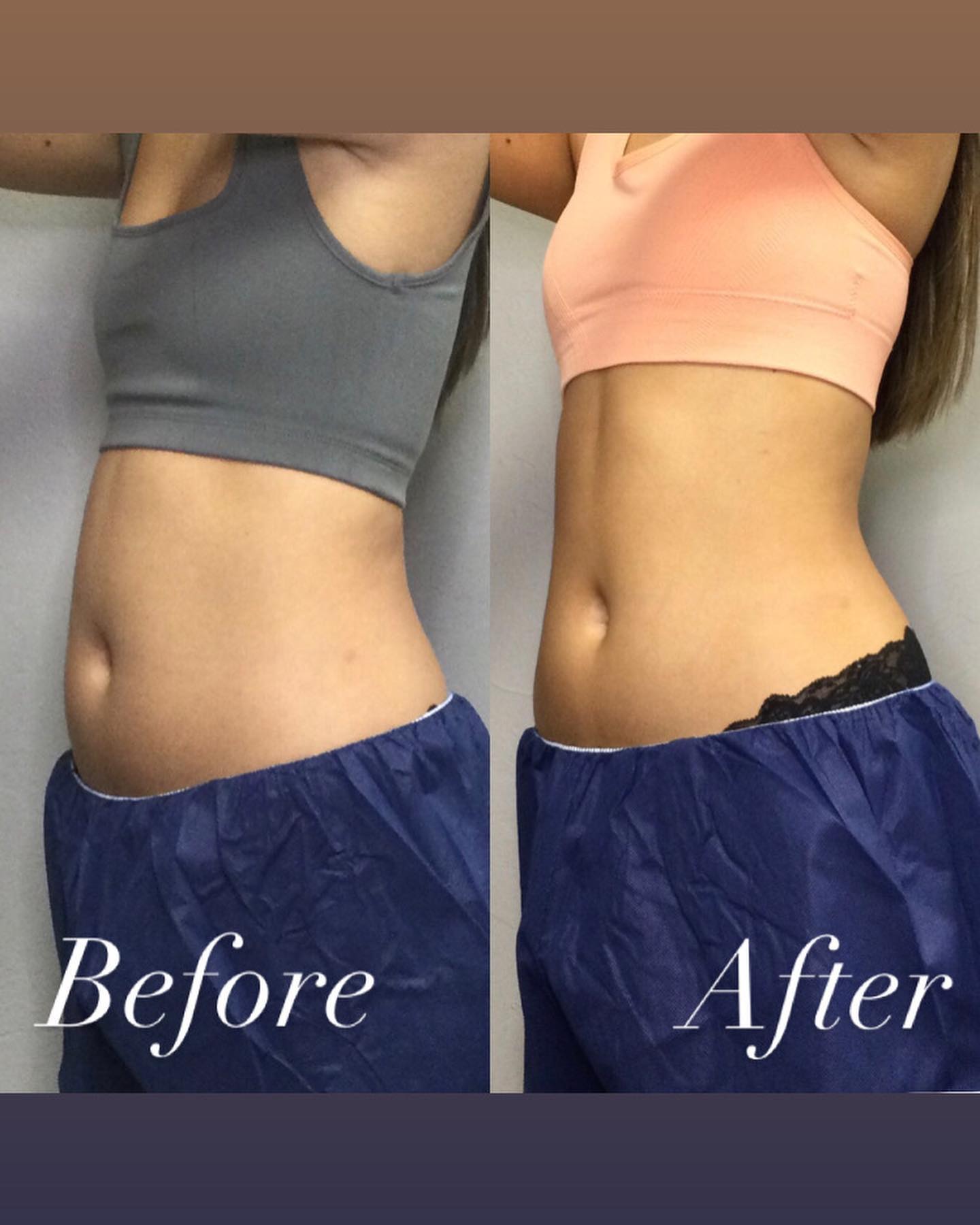 Medical weight loss before and after showing abdominal fat reduction and body contour improvement