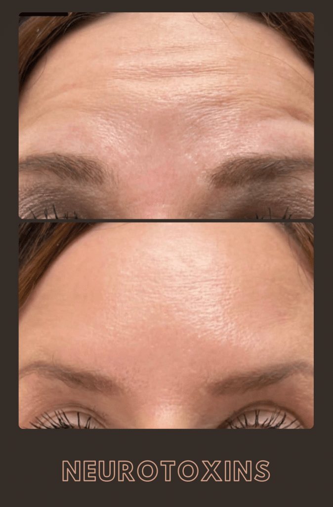 Neurotoxins before and after showing visibly softened forehead fine lines and a smoother appearance.